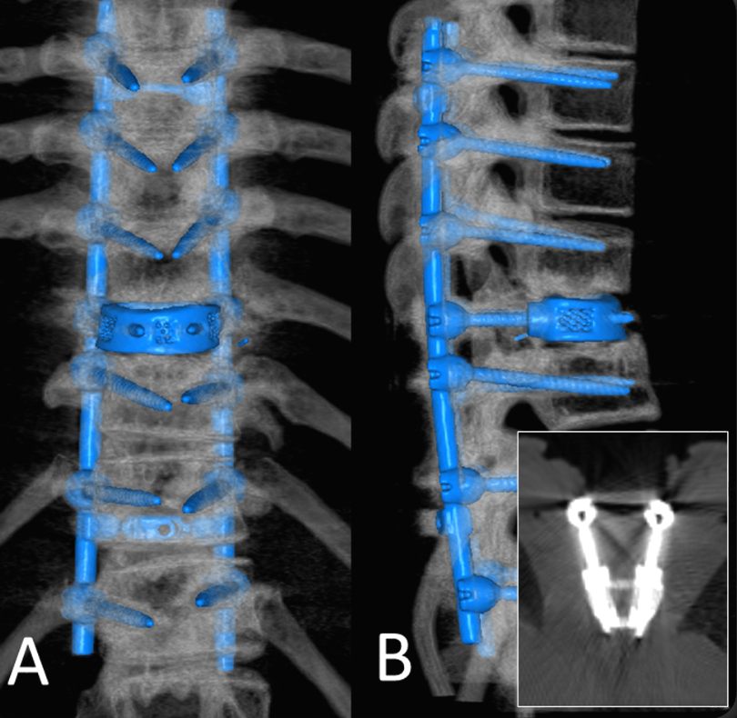 spinal-operation Spinal operation